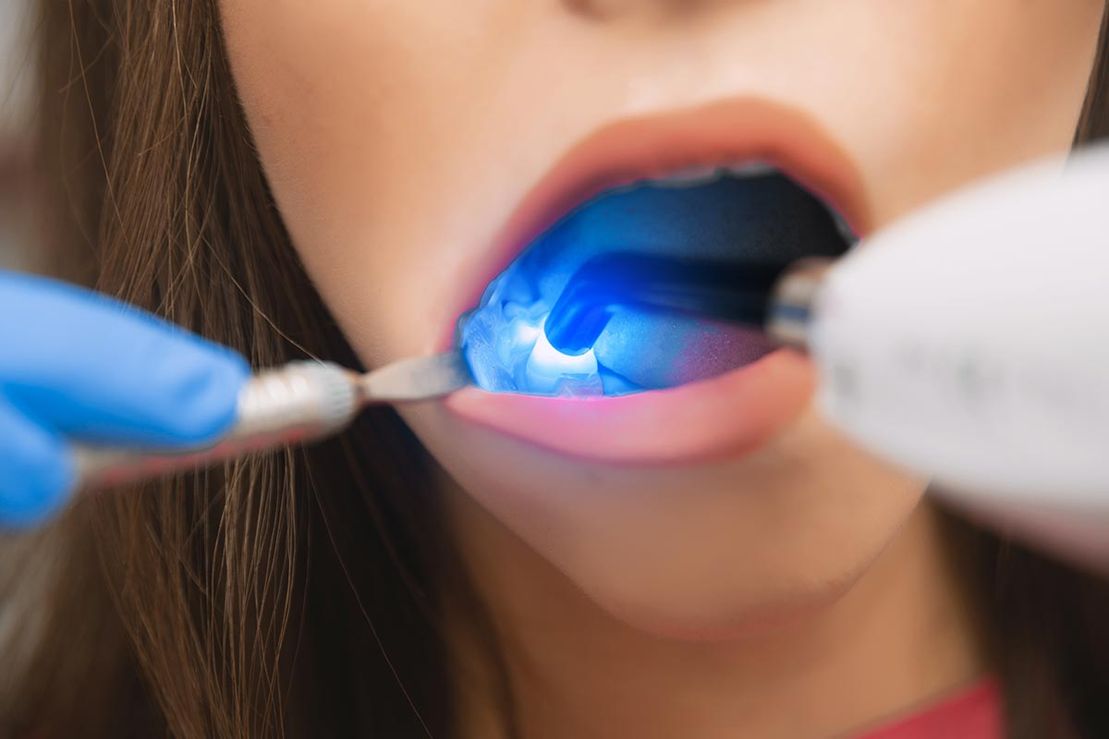 Lasertherapie beim Zahnarzt